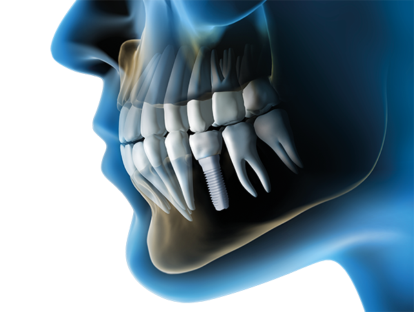 Z-SYSTEMS Implants